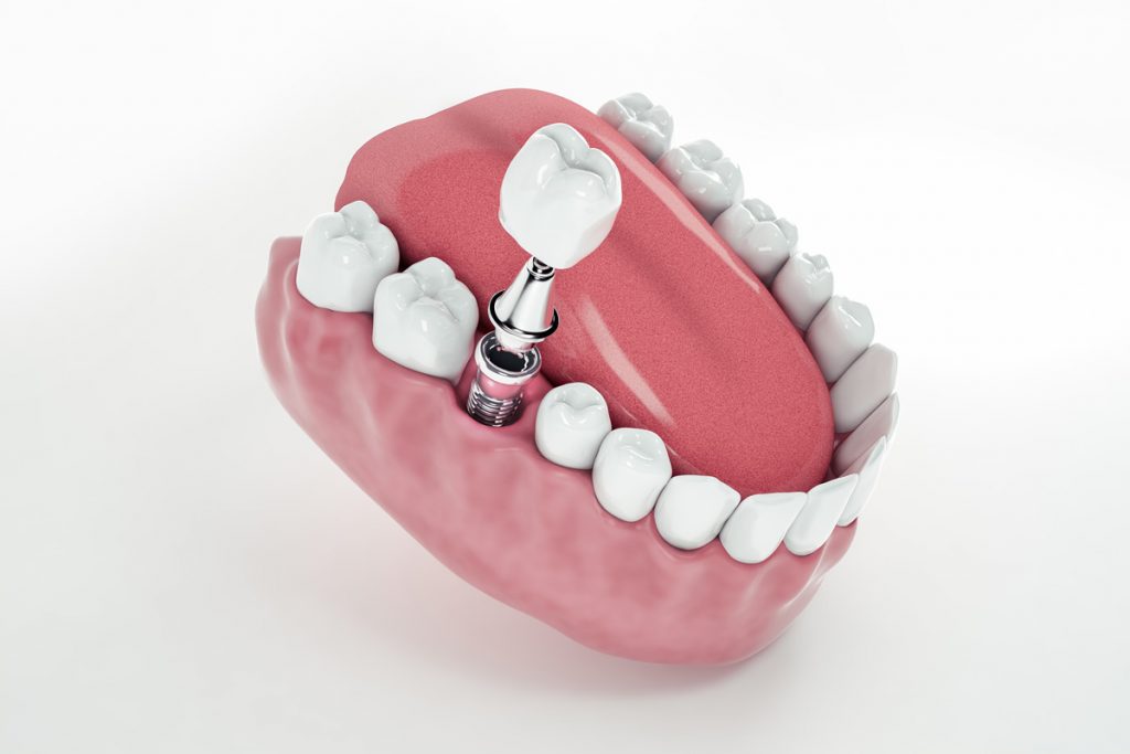 Implantate in einem 3D Modell