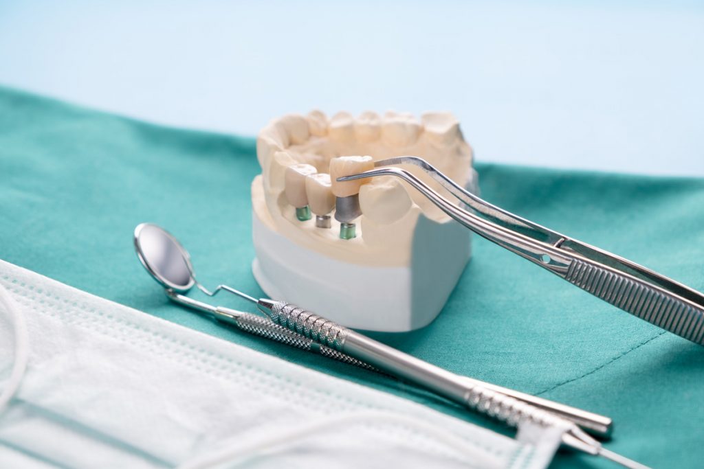 Implantate werden in ein Modell eingesetzt