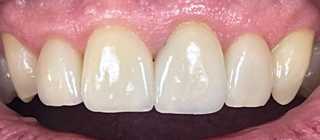 Bild einer Zahnreihe mit Veneers