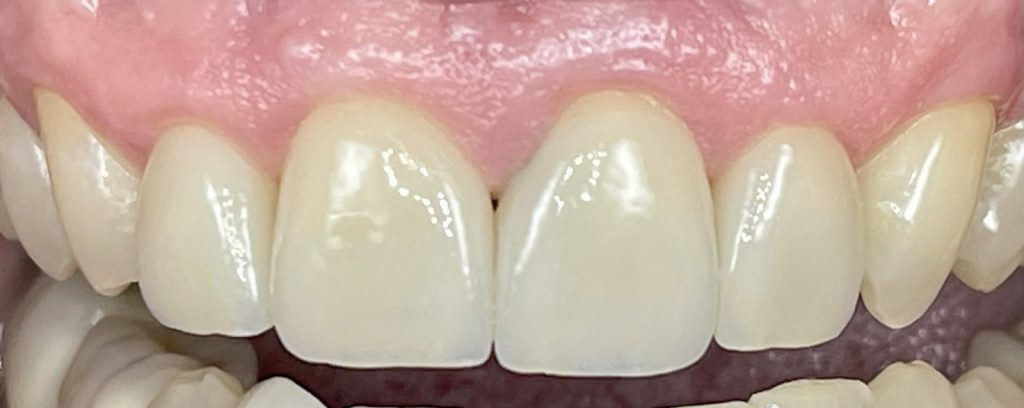 Bild von Frontzähnen mit Veneers