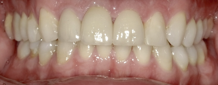 Bild einer Zahnreihe mit Veneers